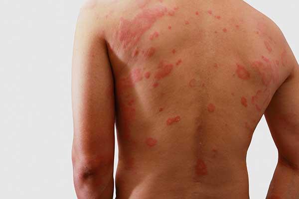 symptoms/skin-rashes.jpg